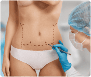 Abdomen ready for tummy tuck procedure