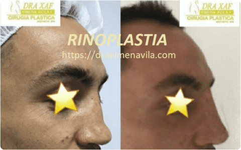 Rinoplastia II